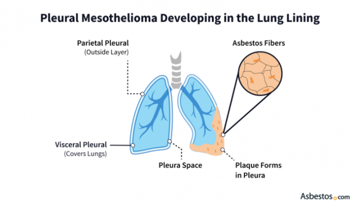 Pleural Effusions In Lung Cancer Detection And Treatment