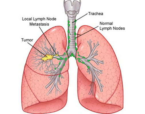 Lung-Cancers