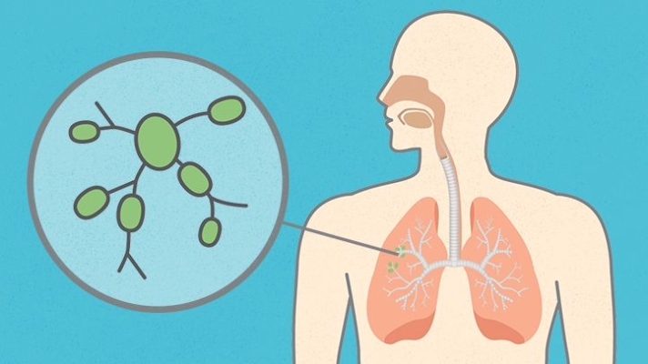 What to know about swollen lymph nodes in the chest - Interventional ...